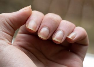 How to prevent the formation of white spots on the nails?