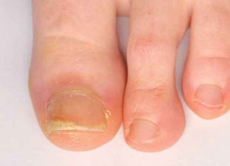 How is nail psoriasis treated?