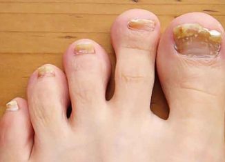What causes thick toenails?