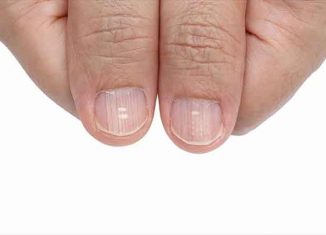 What is the cause of white spots on nails?