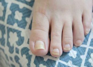 How to fight yellow toenails?