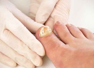 How to prevent and treat nail fungus?