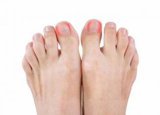 How to prevent ingrown toenails?
